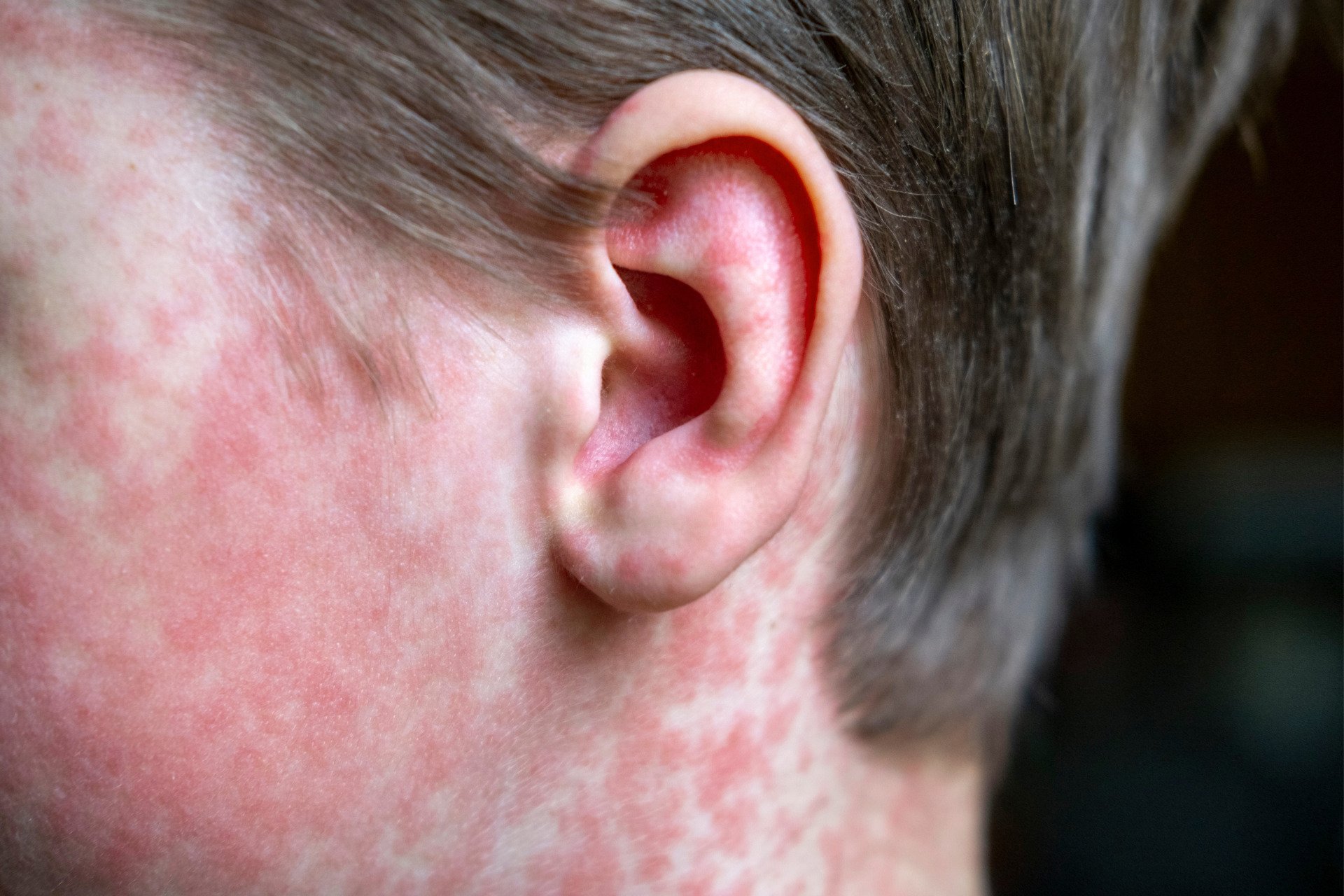 Measles Rash